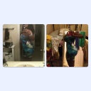 before any surgery on left; after 2nd bbl on right