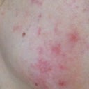 About two hours after glycolic peel, only one side of face is this way