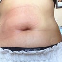 Right after the procedure