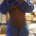 21days post op