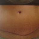 2011 - My scar at 5 months.  Still red & thick in spots, but heard it will fade with time.