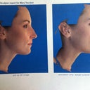 Before and After Imaging done by Dr. Cochran. Looks pretty identical to me!