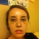 My front of the day my cast came off. I still have some bruising, but I totally loved my front ! My nose is so much shorter and cuter !!!