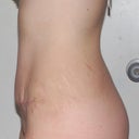 Side View - 3 weeks post op