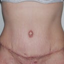 Front view - 3 weeks post op