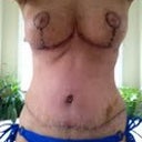 Bathing suit pulled down so you can see scar...still swollen but much better than before