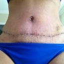 Bathing suit pulled down for a better look at incision area