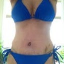 Bathing suit in normal position...side scars very visible