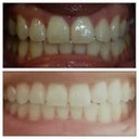 Above picture is the before. It was taken by at orthodontist. Below is the after.
