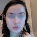 My skin on day 27, red marks are semi-visible (sorry for poor quality and creepy post-shower pic, taken on my macbook). Skin looks a lot better than it did 4 days ago, but then it seems to go in cycles so I am not getting my hopes up.