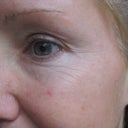 eye lines before laser