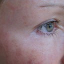 Day 3 eye after laser