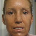 Day 3 after laser