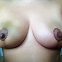 3 weeks post op
