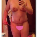 PO Day 5 - You can really see the swelling on the non-drain side and the sides of my breasts.