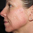 Day #6 Left side - the side with more pre-fraxel skin issues.