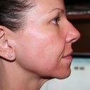 Day #6 Right side - finaly starting to look more normal - though still red/scaly below my mouth.