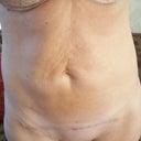 6 months post-op