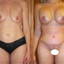 11 days post op and 3 week post op comparison.