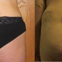 11 days post op and 3 week post op comparison. I seem to be more swollen and the skin is dimpling on one side:(