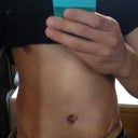 10 Days Post-Op