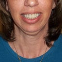 Frontal view before surgery