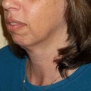 Left side view - before surgery