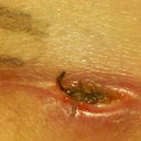 Issues healing and what looks like the start of infection. Treated it with neosporin for two weeks. WOULD NOT HEAL!