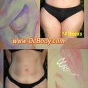 Before surgery and 14 Weeks after from Dr D's Office Composite that he gives to his patients :)