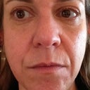 3 months post final Fraxel. No makeup.