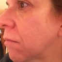3 months post final Fraxel. No makeup.