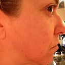 3 months post final Fraxel. No makeup.