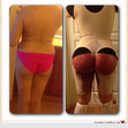 2 day post op Booty Before 39 inch After 43 in. Looks much bigger with smaller waist