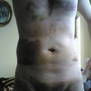 After laser liposuction