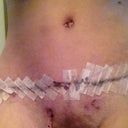 beauty is pain.. yikes. 11 days po. I do like the way my waist is turning out :)