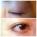 6 months post -op/ close up scar views on upper & bottom lids. Very fine lines. Undetectable with naked eye per family