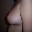left side 6 days post op
