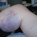 Post Opp day 1 Lipo on thighs