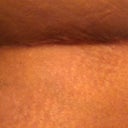 Other side still swollen.