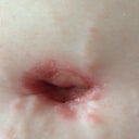 in the 5th week I developed a heat rash on my BB!!  The whole time I had that huge belly and never had one b4!!  Alot of firsts for me on this journey
