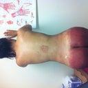 1 day after the sugery at the office of dr salami