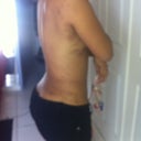 5 day post op