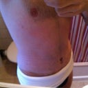 Post Op - Day 7 - One week down and swelling is improving.