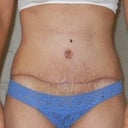 2 weeks post op - front view