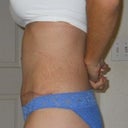 2 weeks post op -side view left