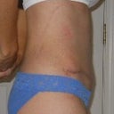 2 weeks post op - side view right
