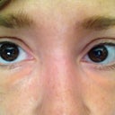 3 Months with Beletero Filler