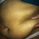 pre op side view yuk!