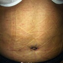 10 day post op still swollen