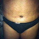10 day post op